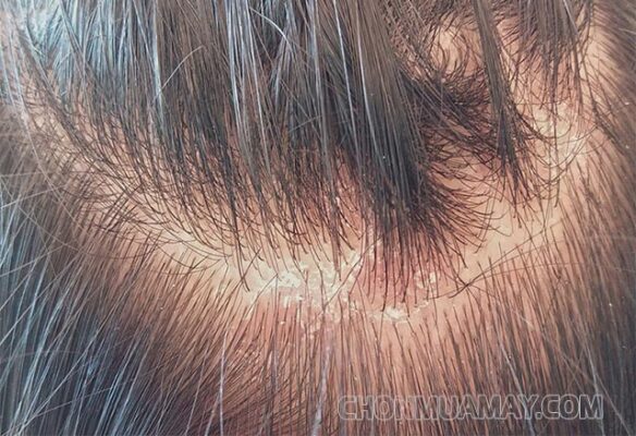 Nguyên nhân gây nấm da đầu là gì?